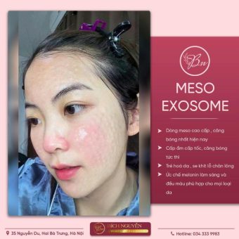 Địa chỉ tiêm Meso căng bóng da tại Hà Nội