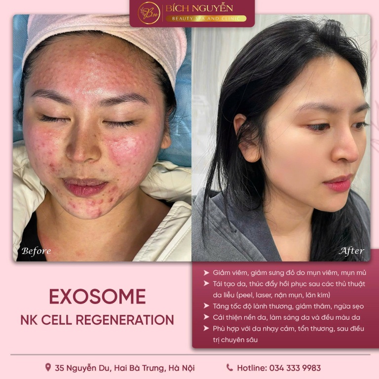 Địa chỉ tiêm Meso căng bóng da tại Hà Nội