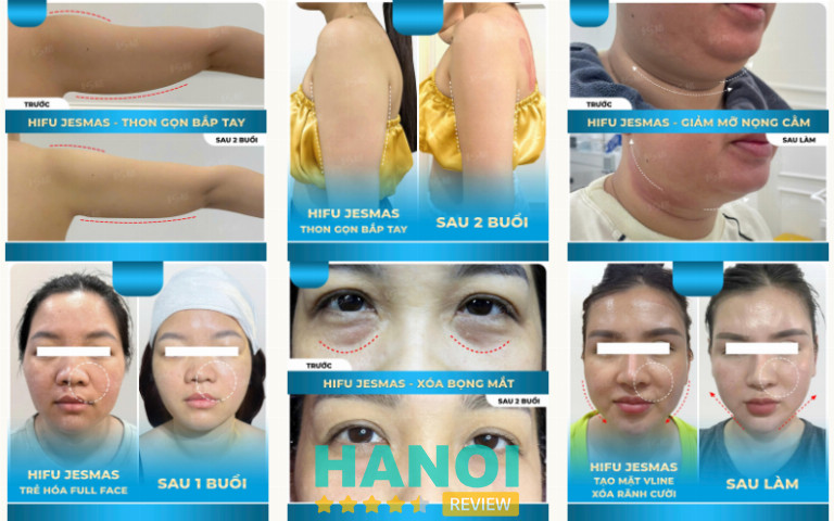 HIFU Jesmas US360D 