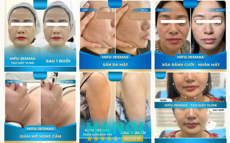 máy nâng cơ trẻ hoá da HIFU Jesmas US360D 