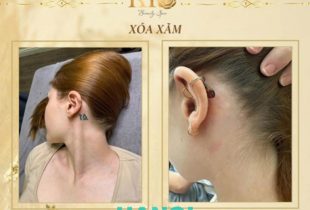 Xóa hình xăm laser an toàn, không sẹo tại Thẩm Mỹ Rio