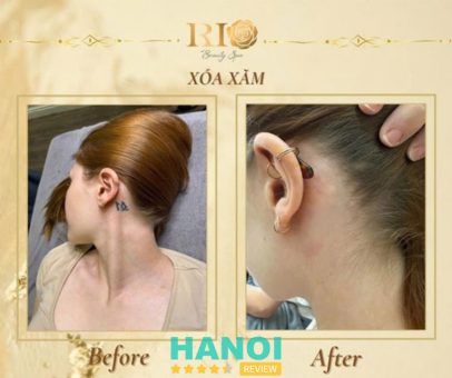 Xóa hình xăm laser an toàn, không sẹo tại Thẩm Mỹ Rio