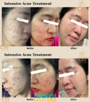 địa chỉ nặn lấy nhân mụn Hà Nội