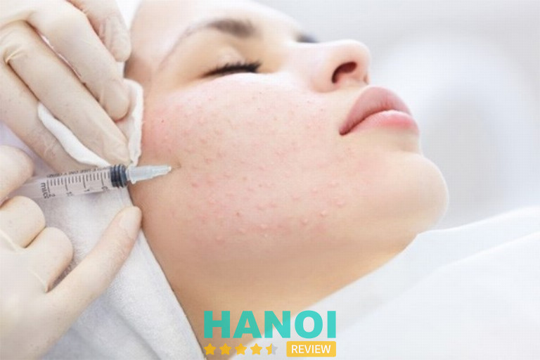 địa chỉ tiêm trị sẹo ở Hà Nội 
