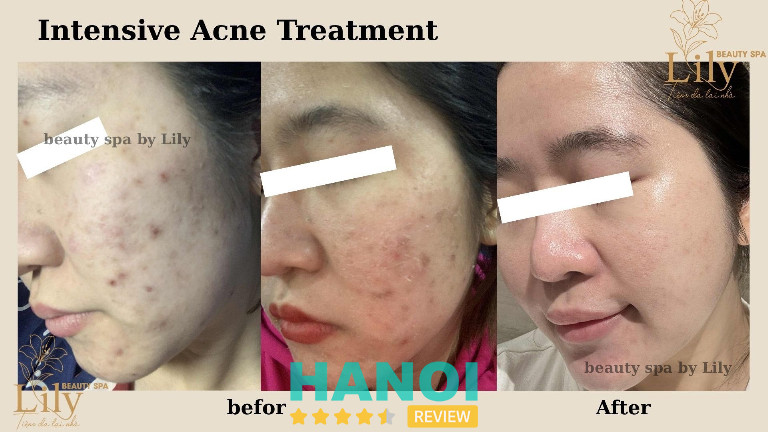 Tiệm DA Tại Nhà - Lily Beauty trị mụn tại Hà Nội Tiệm DA Tại Nhà - Lily Beauty trị mụn tại Hà Nội