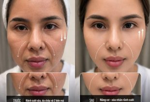 Review xóa rãnh cười tại LG Clinic có thật sự hiệu quả như nhiều người chia sẻ? 