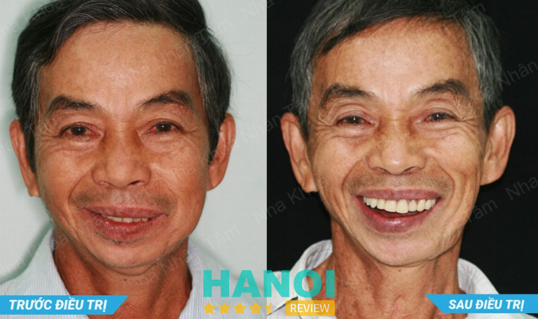 Mỗi khách hàng tại Nha khoa Nhân Tâm được thăm khám và tư vấn phương án trồng răng Implant phù hợp với tình trạng cụ thể