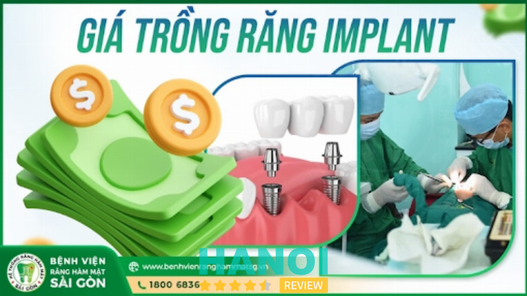 Chi phí trồng răng Implant tại Bệnh Viện Răng Hàm Mặt Sài Gòn tùy loại trụ, vật liệu và tình trạng răng